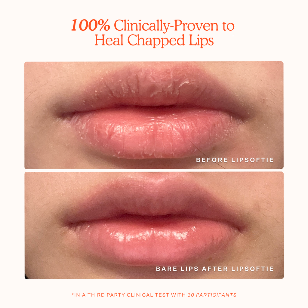 LipSoftie® Lip Treatment R4