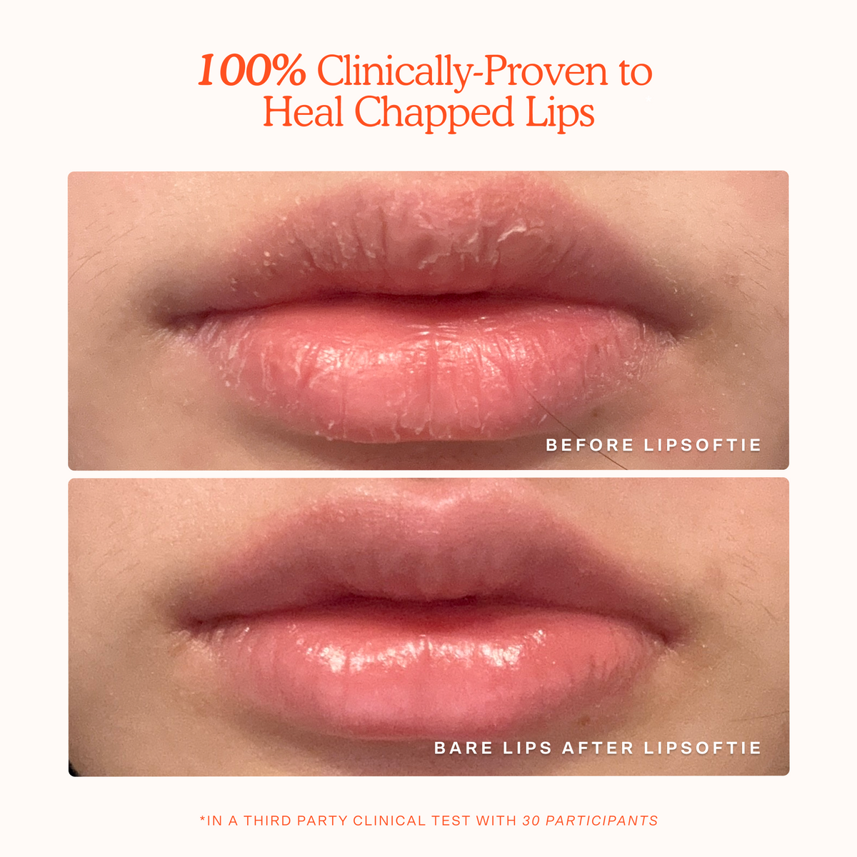 LipSoftie® Lip Treatment R4