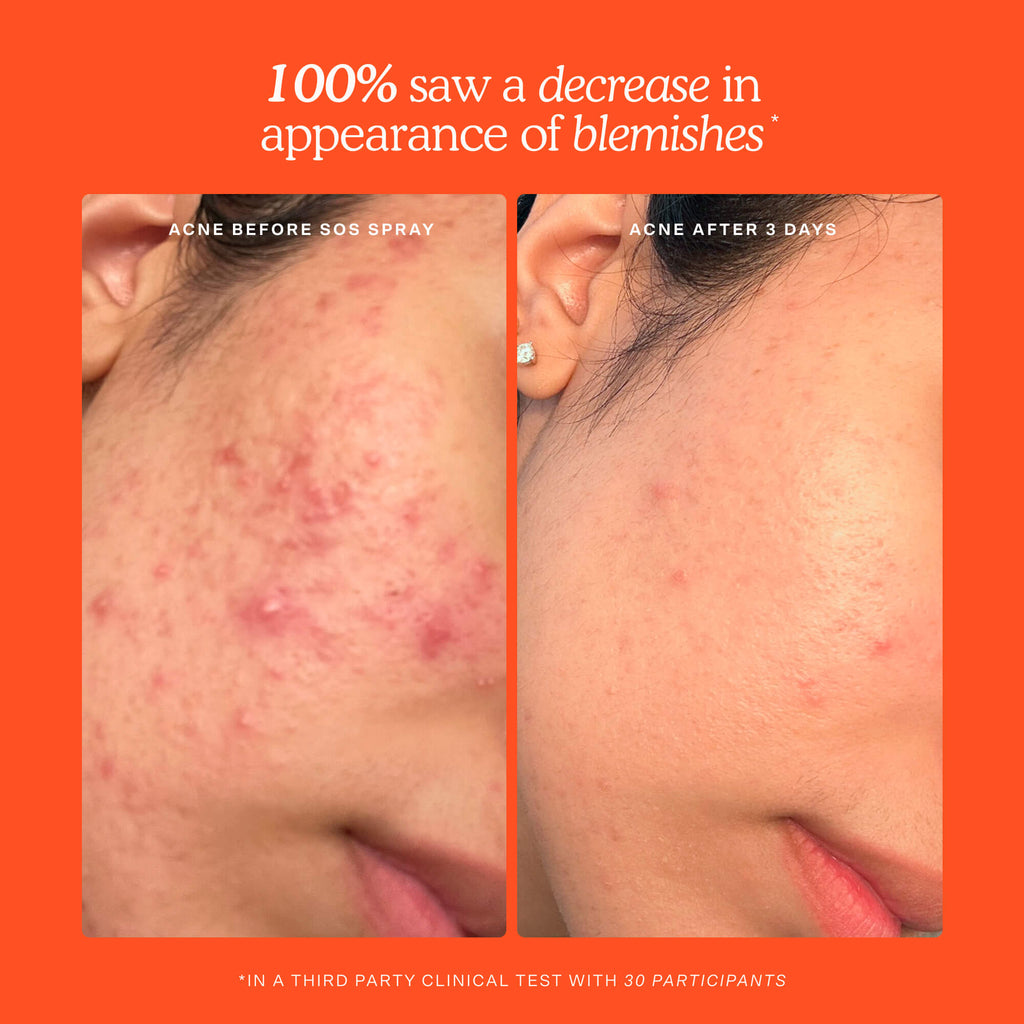 SOS Skincare Minis Kit R9