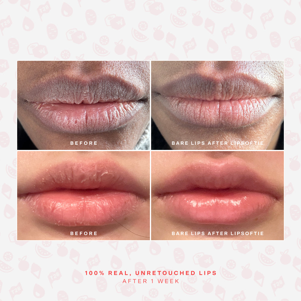 SOS LipSoftie® Lip Treatment M1