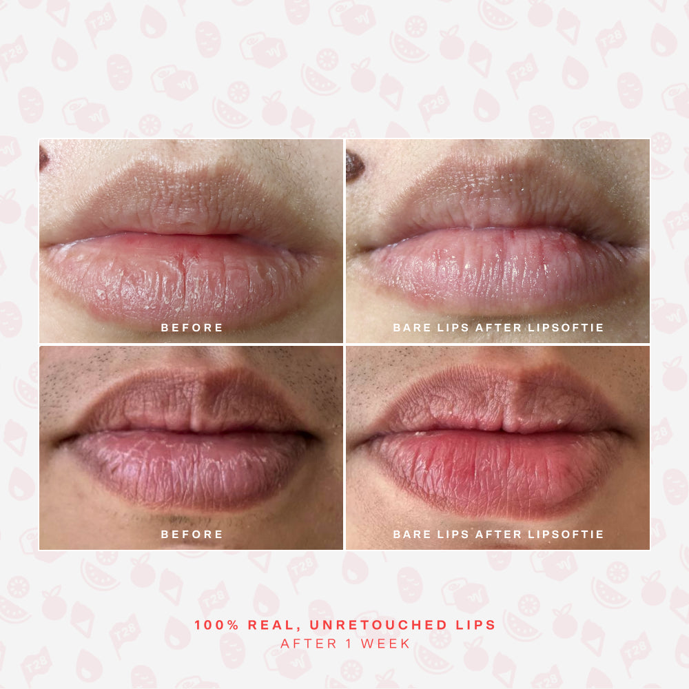 LipSoftie® Lip Treatment Set H1
